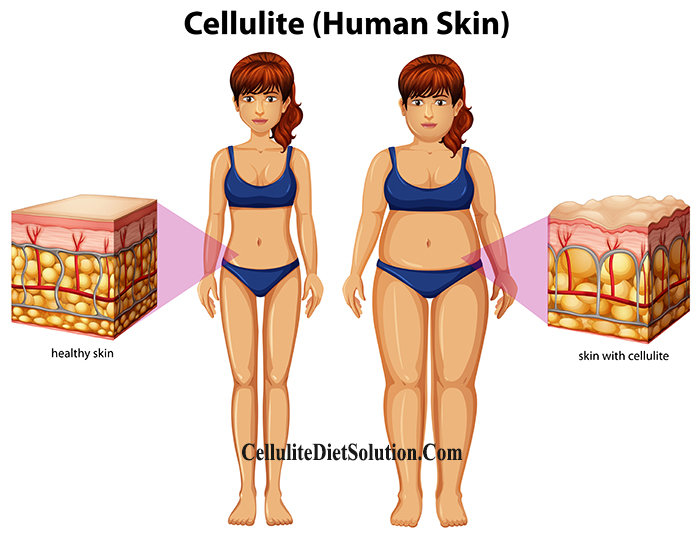 Causes of Cellulite - Ways to Reduce Cellulite Naturally